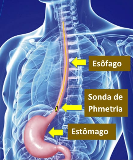 Phmetria Esof Gica Computadorizada Hs Cefidi