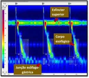 Manometria do esôfago de alta resolução CEFIDI