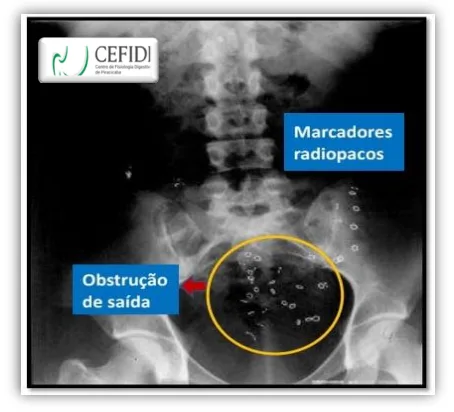 Exemplo de exame de trânsito colônico